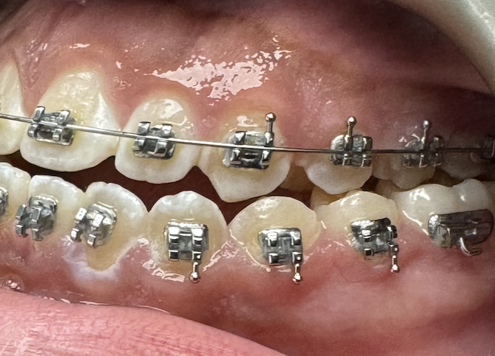 Crossbite: upper teeth biting inside the lower teeth, shown during braces treatment