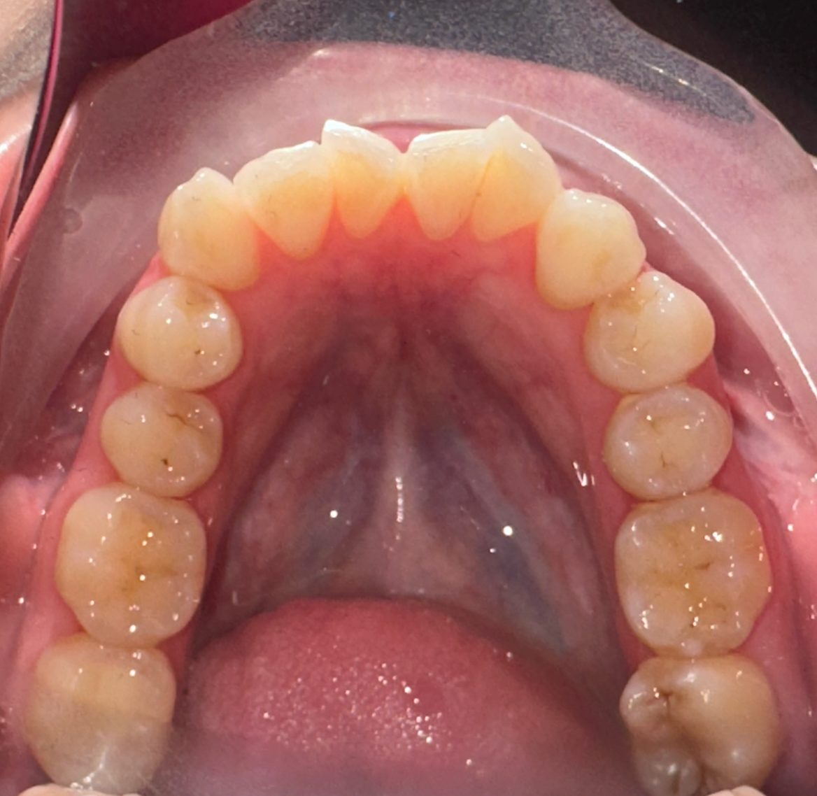 Occlusal view of crowded, overlapping front teeth