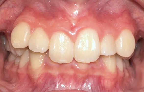 Deep bite: upper front teeth covering most of the lower teeth