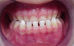 Underbite: lower teeth sitting in front of the upper teeth