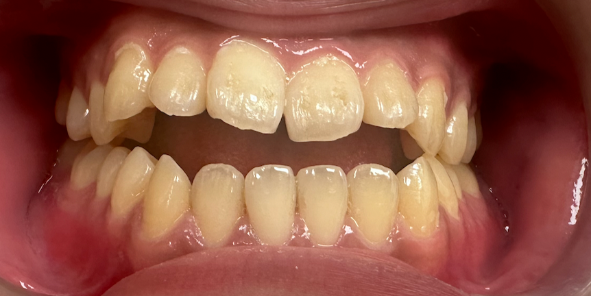 Open bite: front teeth not touching while back teeth are closed