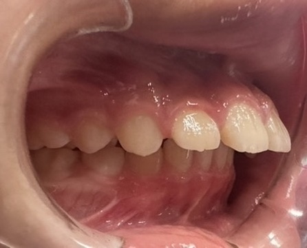 Side view of protruding upper front teeth (overjet)