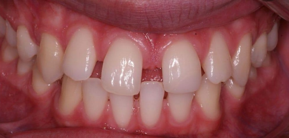 Gaps between the front teeth (spacing)